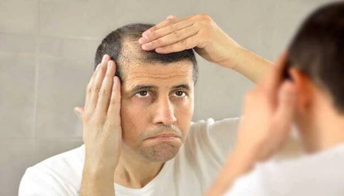 Amazing Home Remedies for Baldness and Hair Fall | Baldness & Hair Fall:  வழுக்கையை போக்கும் 'சில' அற்புத எண்ணெய்கள் | Health News in Tamil
