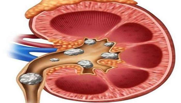 சிறுநீரகக் கல் நோயாளிகளுக்கான உணவுகள்; கட்டாயம் சாப்பிடுங்க