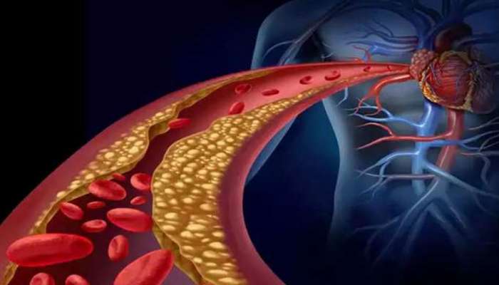 Cholesterol Signs: உடலில் கொலஸ்ட்ரால் அதிகரித்தால் இந்த அறிகுறிகள் தென்படும், ஜாக்கிரதை!! title=