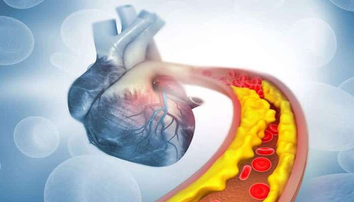 கொலஸ்ட்ரால் அளவு அதிகரிக்கும் போது இந்த 4 பிரச்சனைகள் தோன்றும்