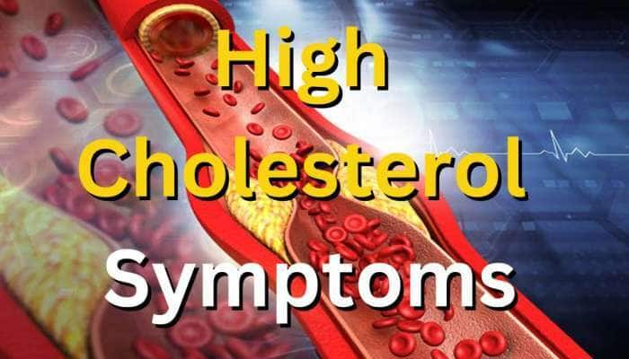 இந்த அறிகுறி தோன்றினால் கொலஸ்ட்ரால் அதிகமாக இருப்பதாக அர்த்தம்
