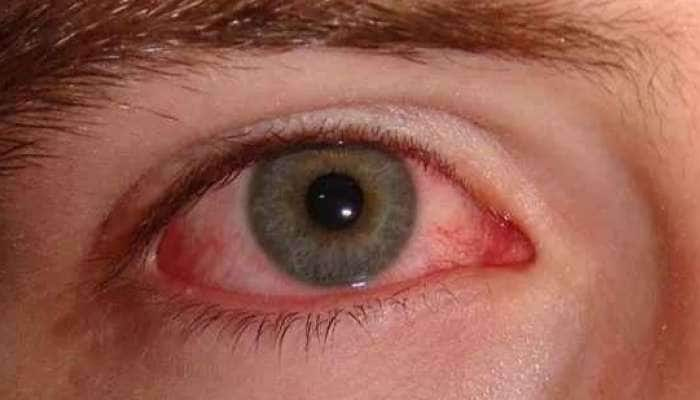 madras-eye-symptoms-news-in-tamil-latest-madras-eye-symptoms-news