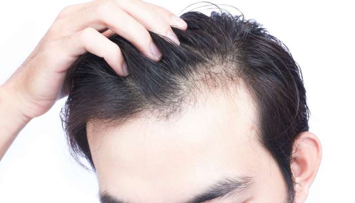 Hair Loss Solution And Tips | முடி அதிகம் உதிர்கிறதா இதை மட்டும் பண்ணுங்க |  Health News in Tamil