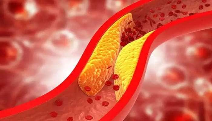 Bad Cholesterol அதிகரிக்கும் போது இந்த அறிகுறிகள் உடலில் தோன்றும் title=