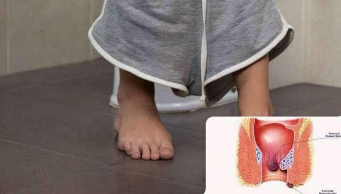 Piles Cure: ஆபரேஷன் இல்லாமல் பைல்ஸுக்கு நிவாரணம் பெற இவற்றை உணவில் சேருங்கள்