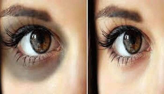 Dark Circles: கருவளையங்களை நீக்கும் ‘சில’ எளிய வீட்டு வைத்தியங்கள்! title=