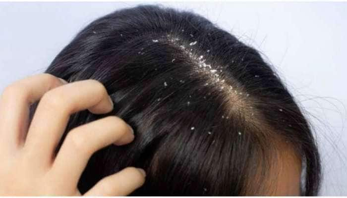 Dandruff: பொடுகு தொல்லை அதிகம் இருக்கா, பாட்டி வைத்தியம் இதோ