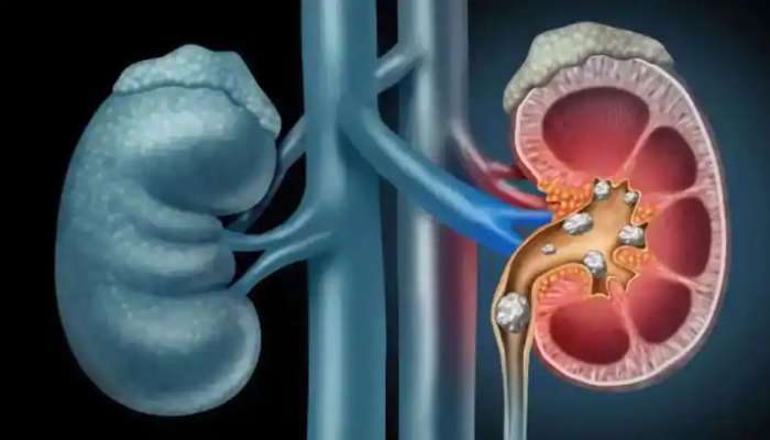 Kidney Health: சிறுநீரக கல் பிரச்சனைக்கு தீர்வைத் தரும் 3 வகை ஜுஸ்கள்! title=