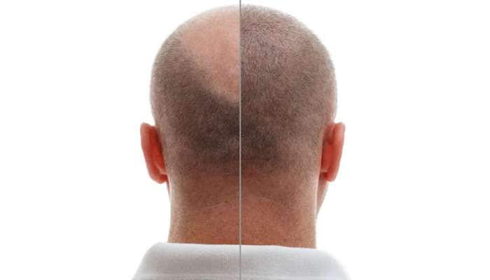 Hair loss treatment: வழுக்கை தலையில் முடி வளர பாட்டி வைத்தியம்