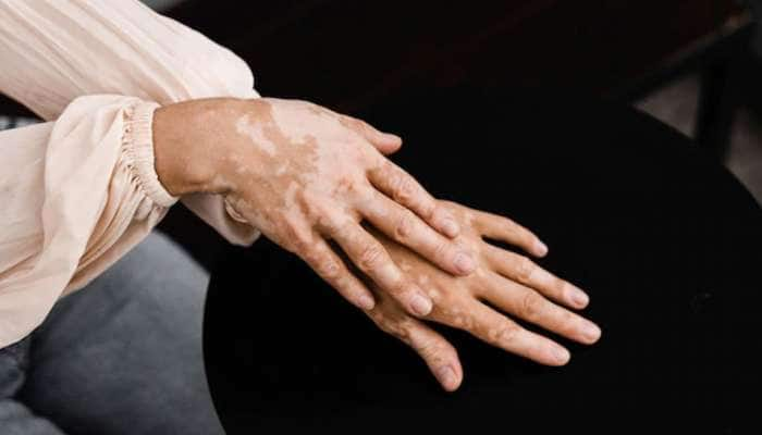 சருமத்தில் உள்ள Vitiligo நோய்க்கான சில எளிய வீட்டு வைத்திய முறைகள்