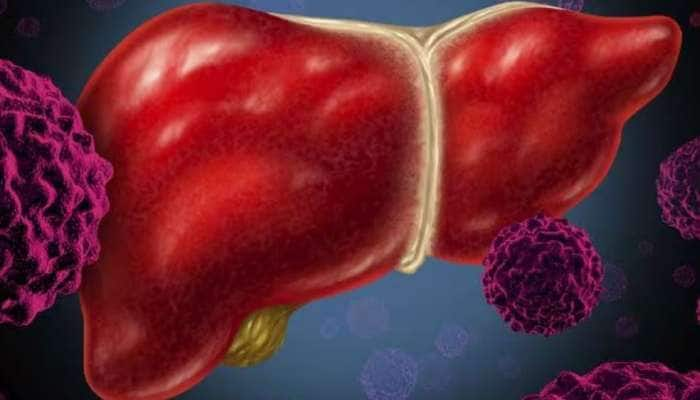 Fatty Liver: கல்லீரல் கொழுப்பை கரைக்கும் சில ‘சூப்பர்’ உணவுகள்!