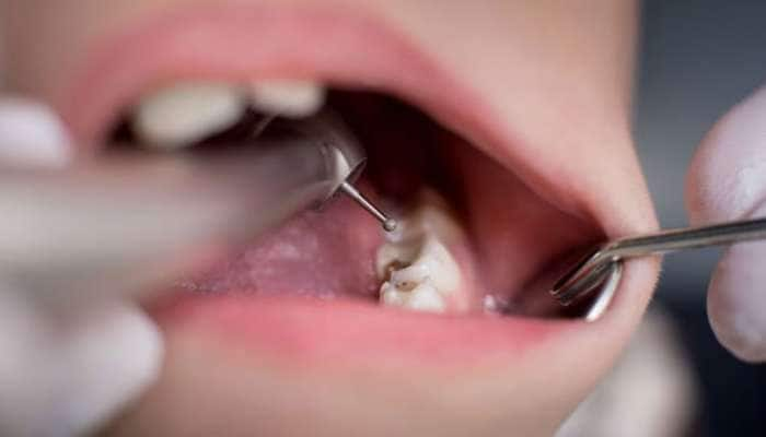 Teeth Cavity: பல் வலி, பல் சொத்தை, பல் கூச்சம் வராமல் தடுக்க டிப்ஸ் title=