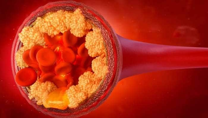 Cholesterol: அதிக கொலஸ்ட்ரால் பிரச்சனைக்கு தீர்வு - இந்த உணவுகளை சாப்பிடவும்...!