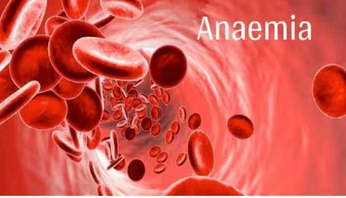 Anemia Alert: இரத்த சோகையா? இரும்புச்சத்து குறைபாடா? இதை செய்து பாருங்க title=