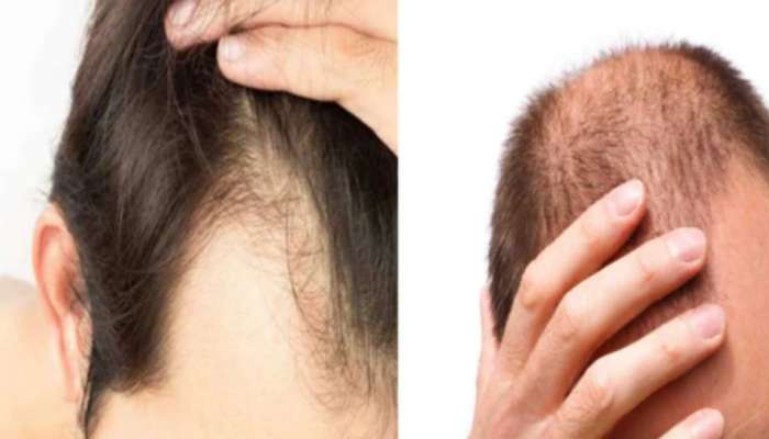 Amazing Home Remedies to prevent Baldness and Hair Fall | ஆண்களின்  கவனத்திற்கு! வழுக்கையை போக்கும் 'சில' அற்புத எண்ணெய்கள்! | Health News in  Tamil