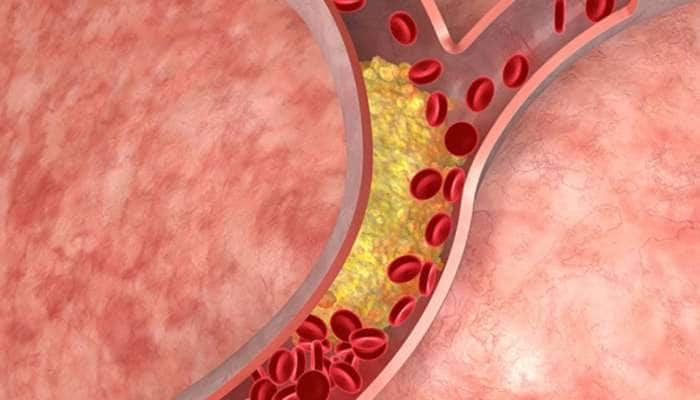 கொலஸ்ட்ரால் ஆபத்துக்கு புதிய மருந்து.! மாரடைப்பு கவலை வேண்டாம்