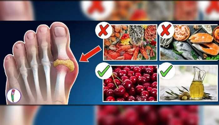 High Uric Acid: யூரிக் அமிலத்தின் அளவுகளை பாதிக்கும் உணவுகள்