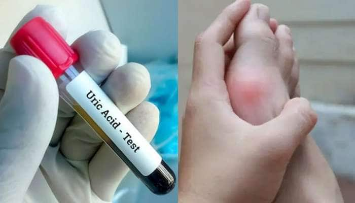 High Uric Acid பிரச்சனையா? இந்த தவறுகளை ஒருபோதும் செய்யாதீங்க