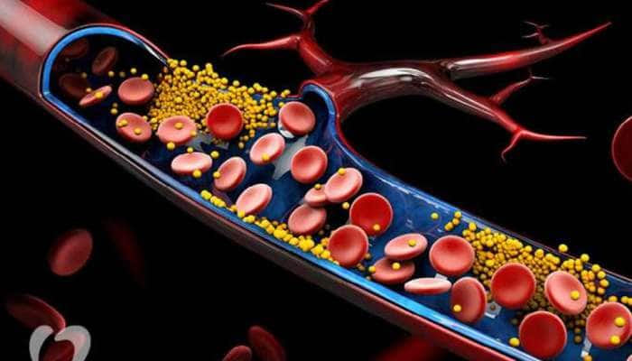 கொலஸ்ட்ரால் அதிகமானால் ஆபத்து: இந்த அறிகுறிகள் தோன்றும், ஜாக்கிரதை!!