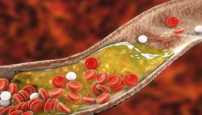 Cholesterol அதிகமானால் இந்த ஆபத்துகளும் அதிகரிக்கும்: ஜாக்கிரதை!!