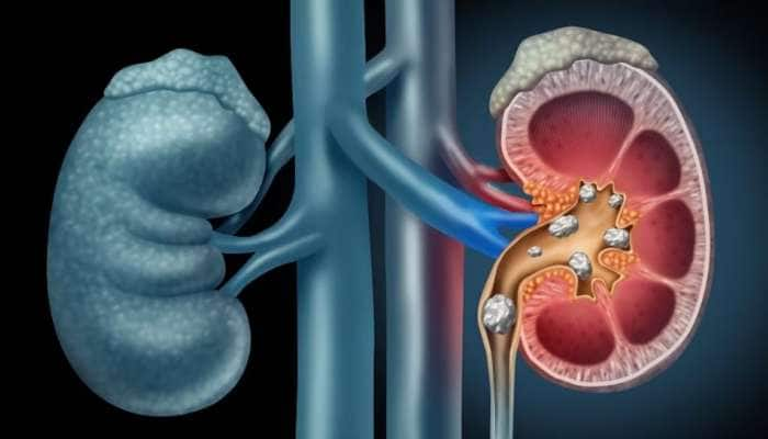 Kidney Stone Diet: சிறுநீரக கற்களை கரைக்கும் சில உணவுகள்!