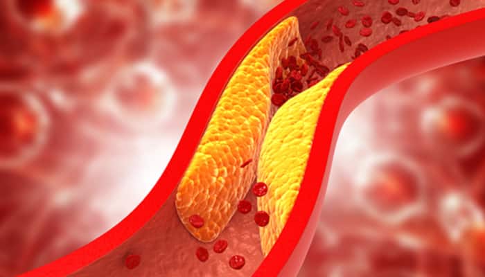 Cholesterol: வீட்டில் உள்ள இந்த 6 பொருட்களின் மூலம் கொலஸ்ட்ராலை குறைக்கலாம்!