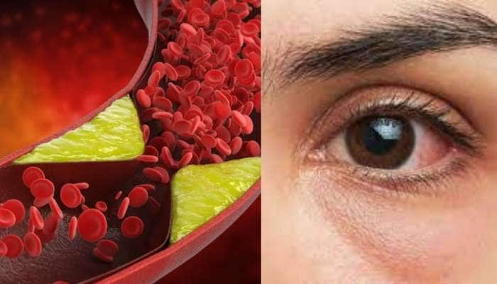 Eye Health: கண்களை பாதிக்கும் கொலஸ்ட்ரால்! என்னவெல்லாம் செய்யும் தெரியுமா? பாதுகாப்பது எப்படி?