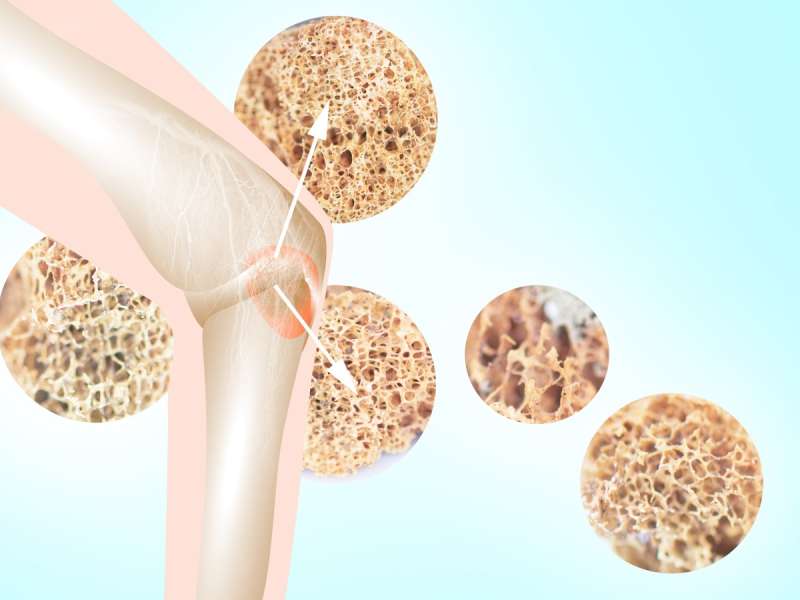 Osteoporosis: எலும்புகளை சல்லடையாய் துளைக்கும் உணவுகளும் பழக்கங்களும்!