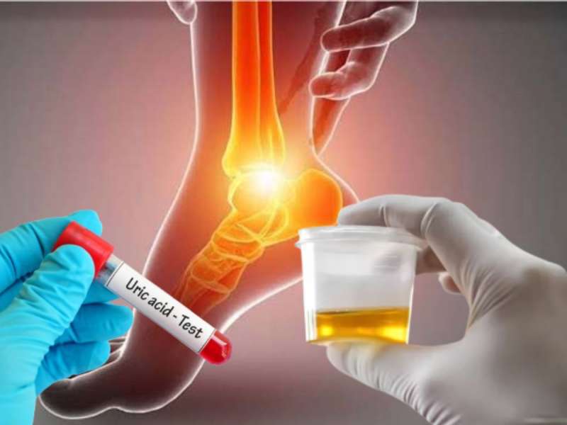யூரிக் அமிலம் அதிகமானால் சிறுநீரில் இந்த அறிகுறிகள் தோன்றும்... அலர்ட் ஆகிடுங்க!! 