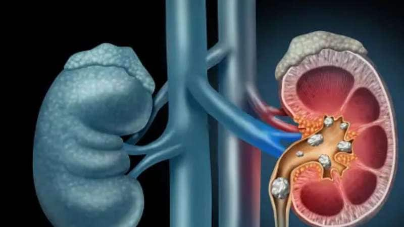 Kidney Stone : சிறுநீரக கல் பாதிப்பு...எதை சாப்பிடலாம்?எதை சாப்பிட கூடாது?