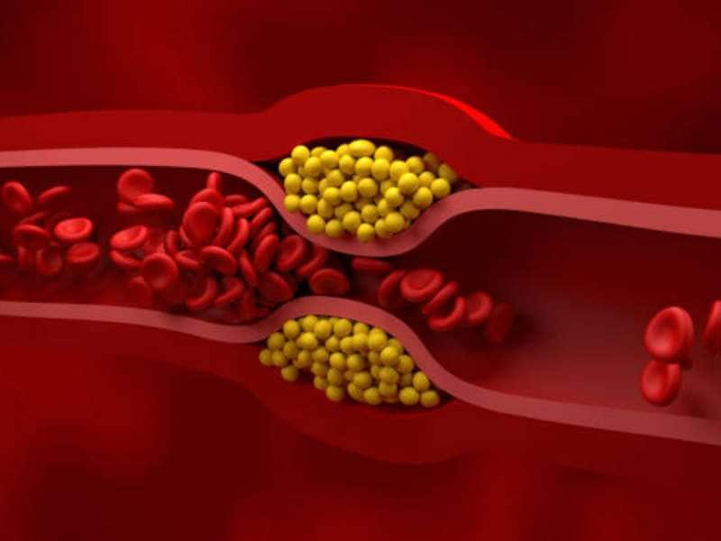 அதிக கொலஸ்ட்ரால் தான் மாரடைப்புக்கு காரணமா? தப்பா நினைச்சிட்டு இருக்காதீங்க