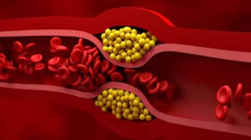 கொலஸ்ட்ரால் அடைப்பு என்றால் என்ன? இதன் அறிகுறிகளை தெரிந்துகொள்ளுங்கள் title=