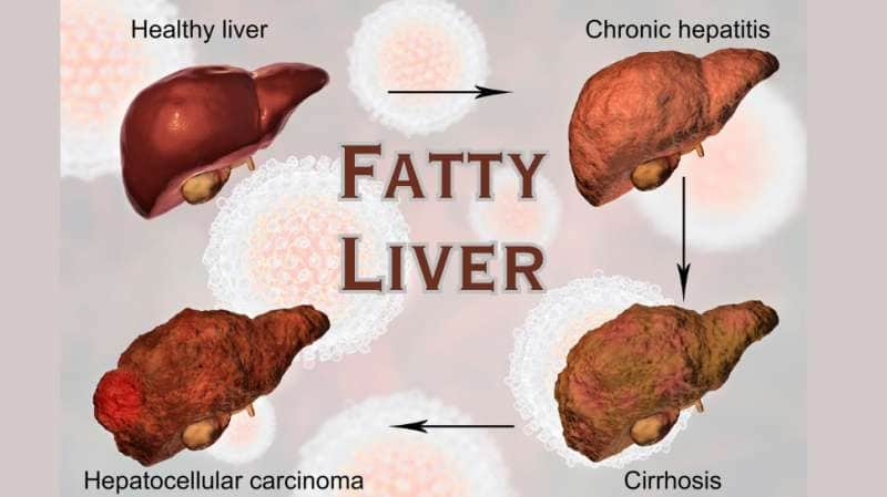 Fatty Liver: கல்லீரலை காலி செய்யும் சில ஆபத்தான பழக்கங்கள்.. title=