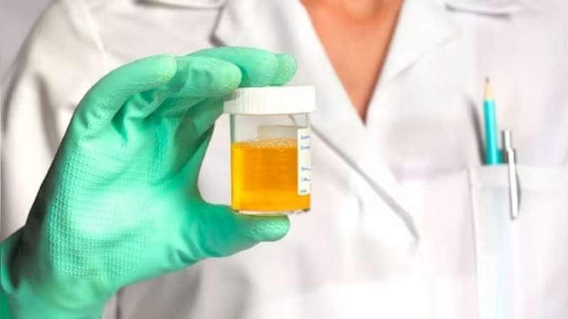 சிறுநீரின் நிறம் சொல்லும் நோய்களின் சீக்ரெட்.... இனிமே கவனமா பாருங்க!!