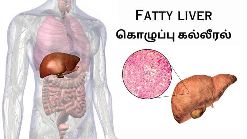 Fatty Liver... கல்லீரலை காலி செய்யும் சில ஆபத்தான உணவுகள்... title=