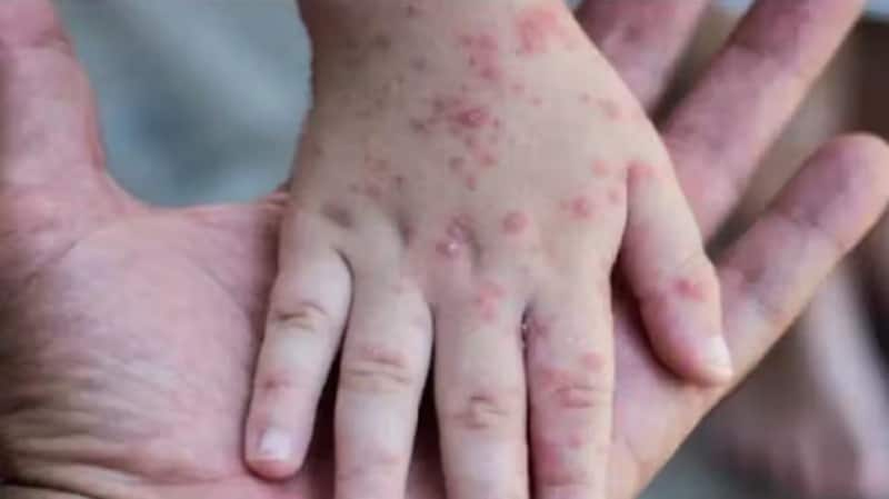 Monkeypox: இந்தியாவில் இன்னொரு நபருக்கு குரங்கம்மை... கேரள நபருக்கு பாதிப்பு உறுதி! title=