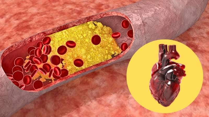 மாரடைப்புக்கு காரணமான LDL கொலஸ்ட்ராலை... எகிற வைக்கும் சில உணவுகள்