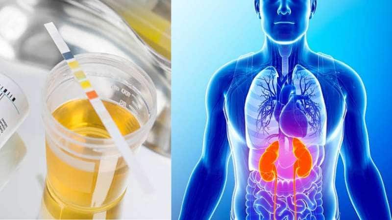 சிறுநீர் வழியாக புரதம் வெளியேறுவதால் வரும் பிரச்சனைகள் - எப்படி கண்டுபிடிப்பது?