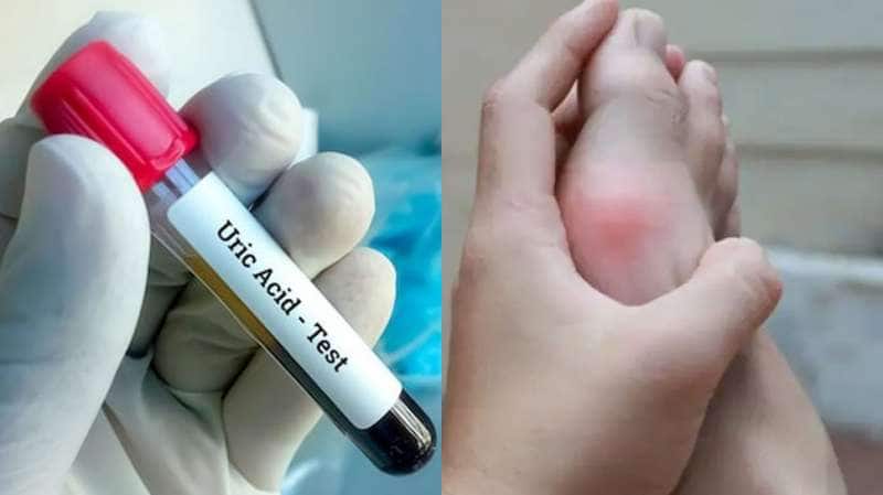 உடலில் உள்ள யூரிக் அமில அளவை குறைக்க... இந்த பானங்களை குடிங்க